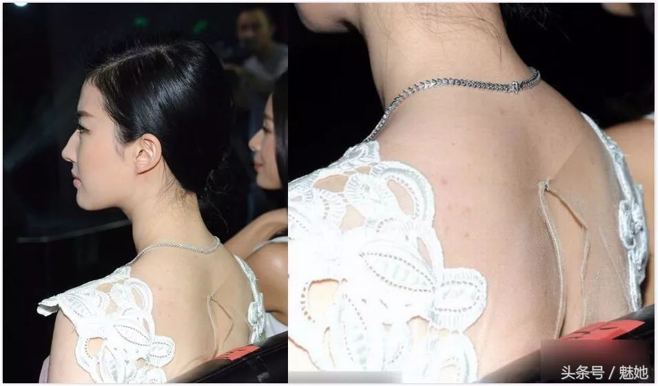 鸡皮肤脂肪痘怎么解决,儿童鸡皮肤怎么护肤