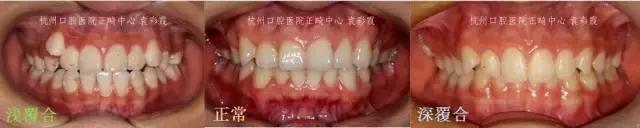 原来，上牙盖住下牙太多，也对牙齿有伤害！该怎么矫正？