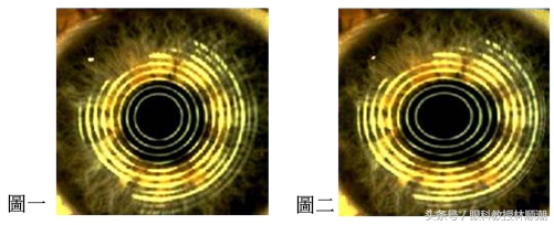 三岁宝宝散光怎么矫正,散光戴眼镜可以矫正吗