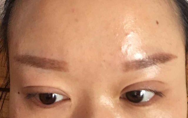 两女子在株洲爱思特万元割双眼皮后，都称“不敢见人”