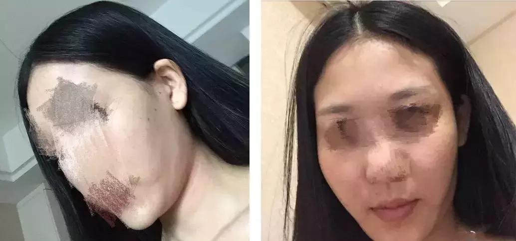 几千块钱做的超声刀，想要逆龄反被毁容？！