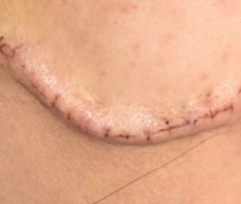 疤痕整形术后恢复过程,疤痕整形手术全过程图示