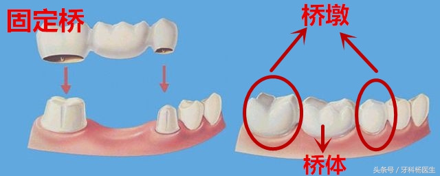 牙根没了镶一颗牙大概多少钱,拔一颗牙再补一颗假牙需要多少钱