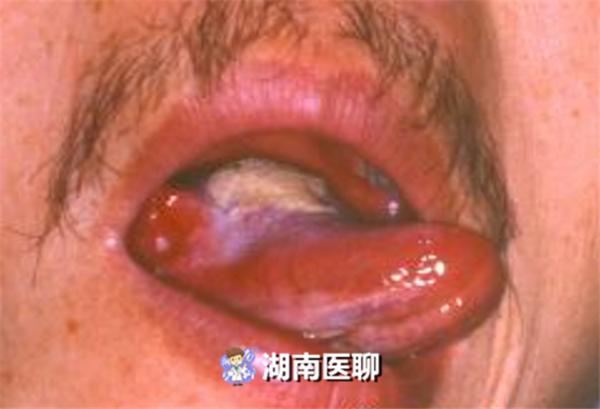 舌头烂了是不是癌症的前兆,舌痛长期不好是舌癌吗