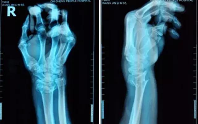 骨折复位后再次移位是什么原因,儿童尺桡骨骨折复位后轻微移位