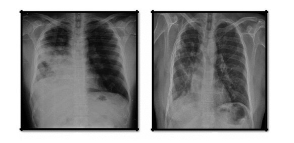印度卡布宁caprane克唑替尼，阿法替尼和奥希替尼真实患者案例