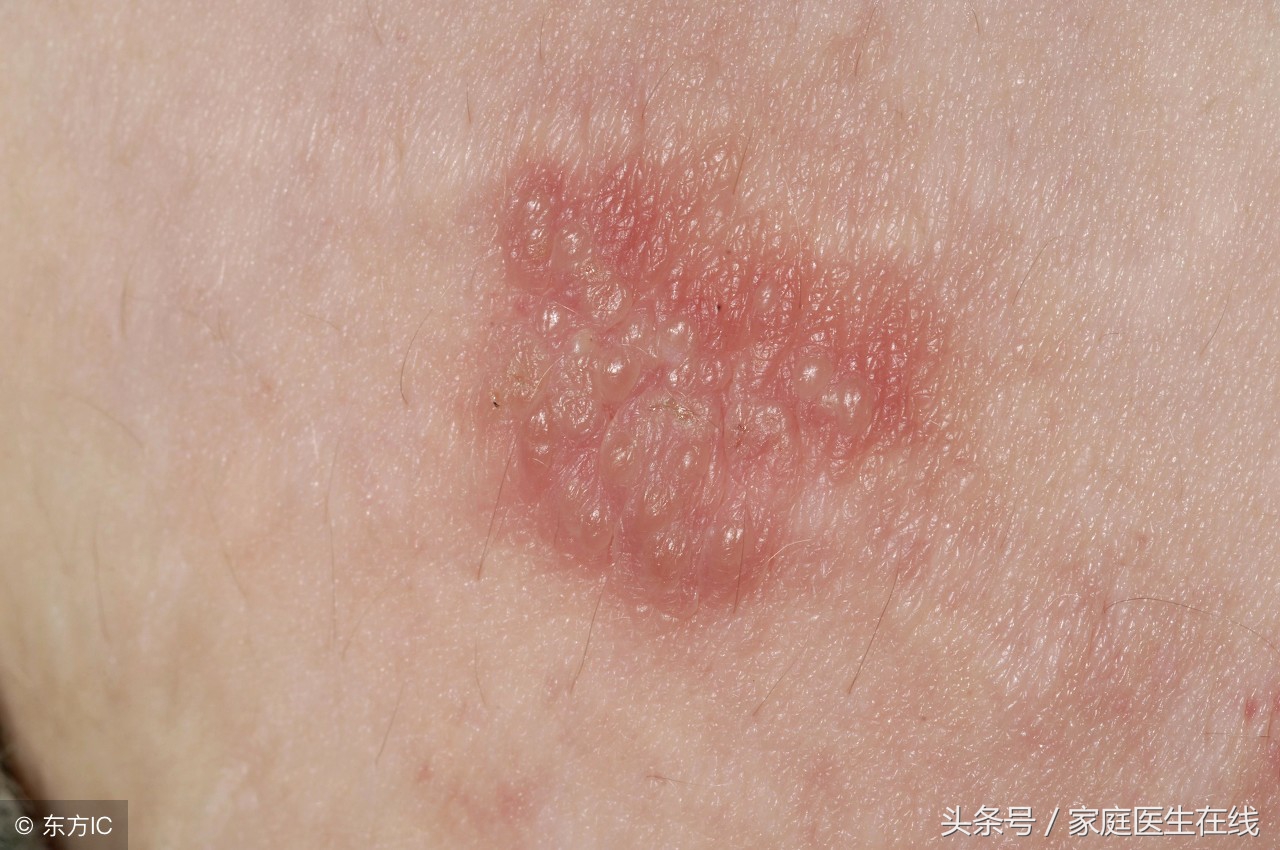 小孩手脱皮缺乏维生素,孩子手脱皮缺乏维生素怎么办