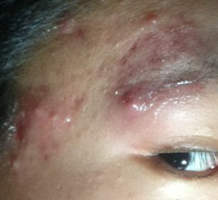 红蓝光祛痘可以去痘坑吗,红蓝光祛痘的最好方法