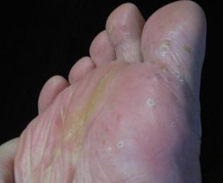 脚气怎么联合用药才好,脚气痒用啥药效果好