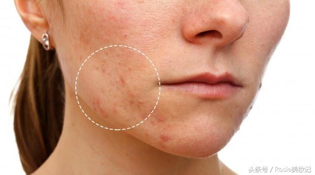 消灭闭口粉刺,脸上长了闭口粉刺怎么解决