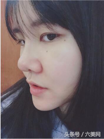 隆鼻后如何克服焦虑,隆鼻后前三天状态