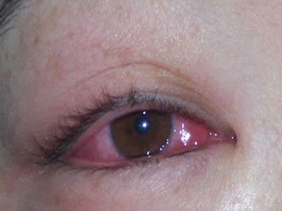 小孩子得了红眼病眼睛会特别红吗,孩子眼睛患红眼病