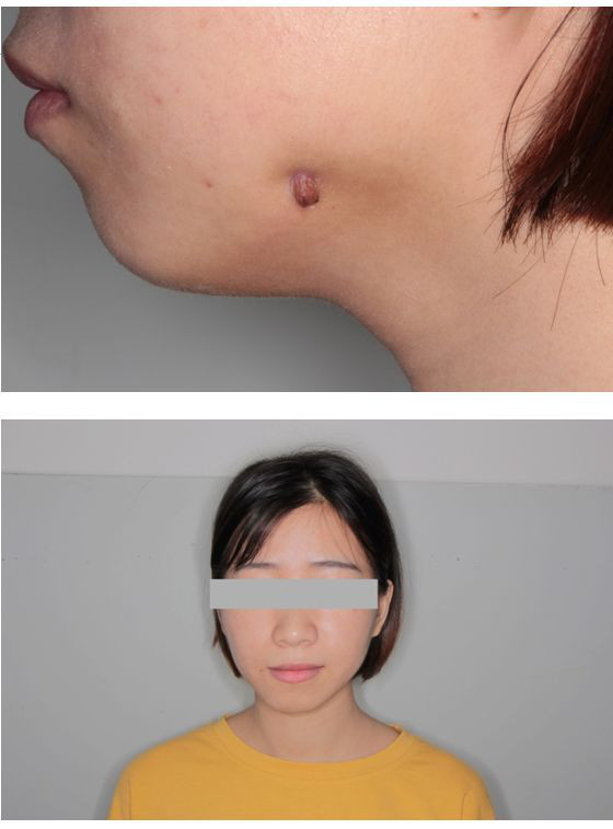 战痘多年才知道的真相,战痘多年不见效果