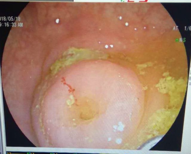 市县专家联动，淳安县中医院成功开展全县首例内镜下逆行阑尾炎治疗术（ERAT）