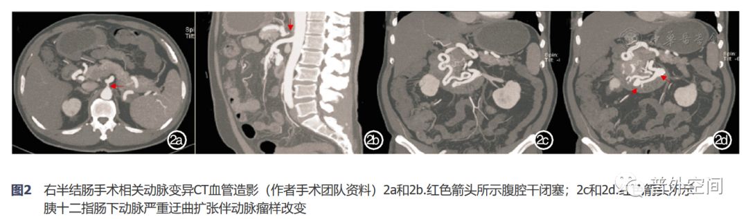 腹腔镜完整结肠系膜切除术相关血管变异与术中出血的应对措施(上)