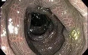 便秘严重喝的茶,一种很苦的茶改善便秘