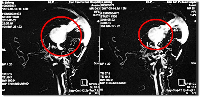 一岁男孩脑子里发现“小苹果”偷血，医生把“钢筋水泥”灌了进去