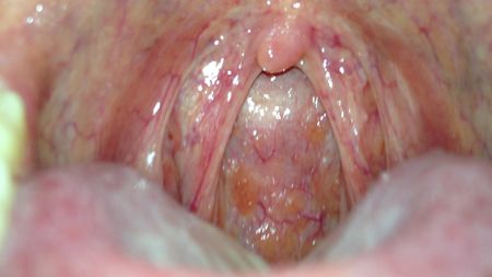 咽喉炎中医怎么治能除根慢性咽炎,中医治疗慢性咽炎有异物感