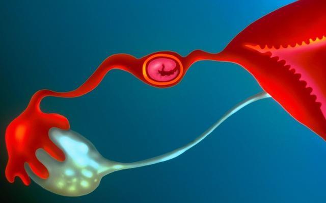 宫外孕患者需要注意的事项,宫外孕的9种病因必须高度警惕