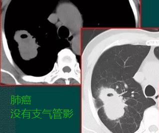 肺上肿块,肺上长出30cm肿块应该怎么办
