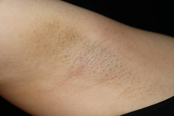 脉冲光去毛,脉冲除胡子