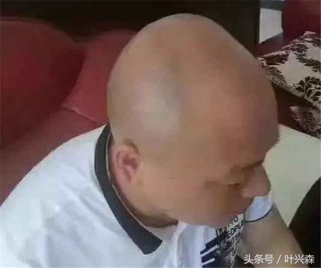 脱发掉发秃顶你该了解生发方法了,秃顶脱发最好的治疗方法