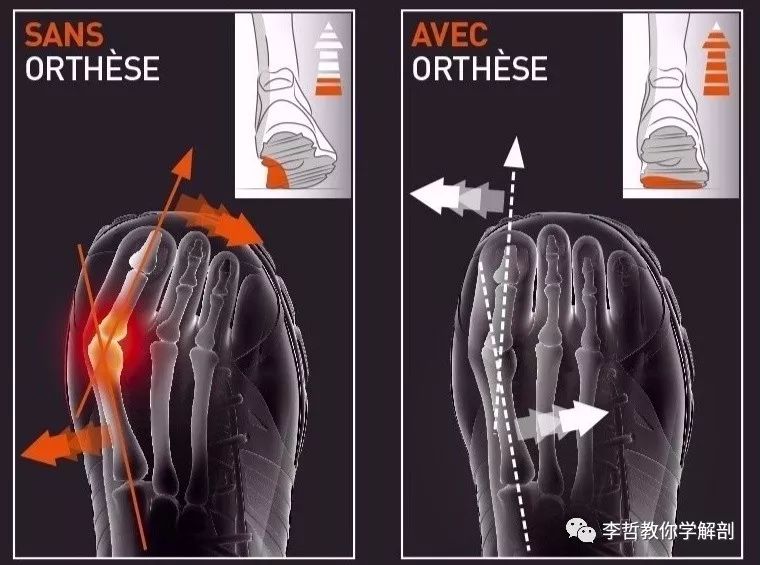 拇外翻该怎么办,拇外翻的解决方法