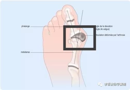 拇外翻该怎么办,拇外翻的解决方法