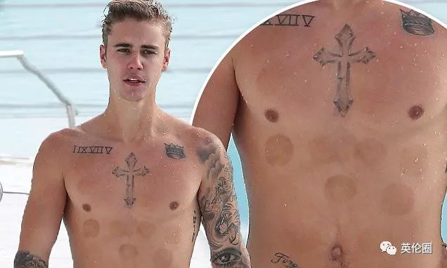 哈里梅根婚前求助中医！歪果仁已经把针灸吹上了天