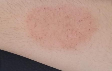 夏天皮肤湿疹怎么治除根,夏季皮肤湿疹有什么特效药