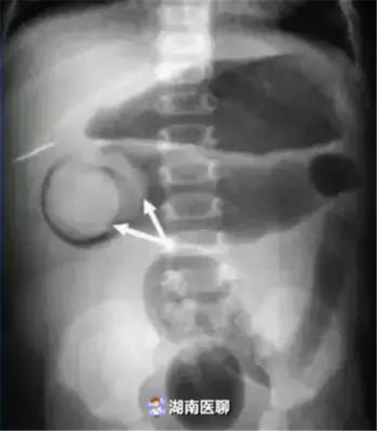 肠套叠灌肠复位后需要注意事项,小儿肠套叠空气复位