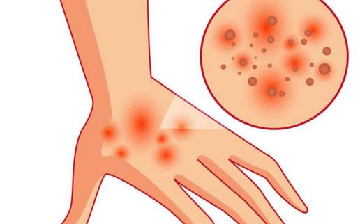 皮肤湿疹痒的原因及解决方法,皮肤湿疹瘙痒用什么中成药有效