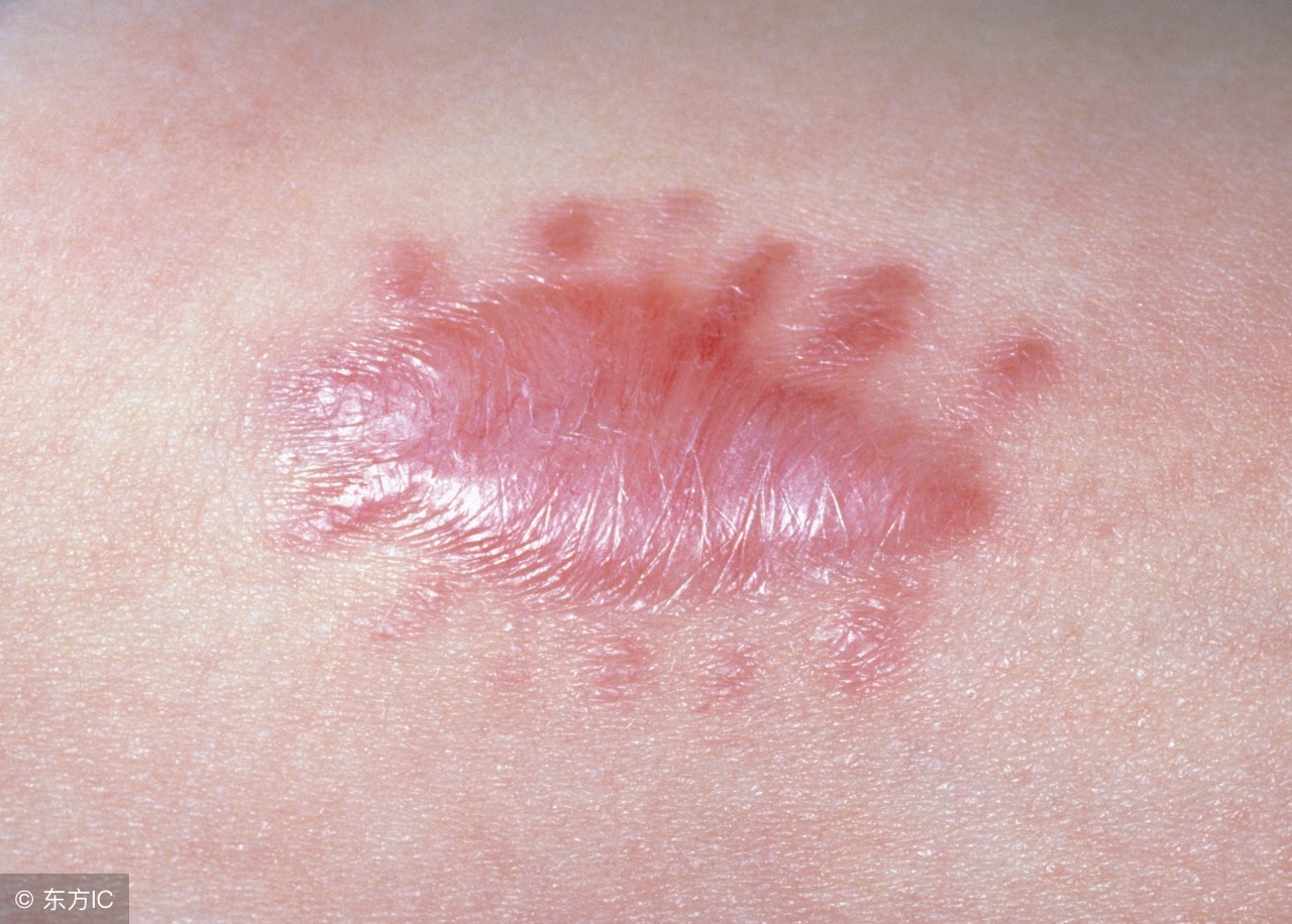 受伤后如何护理才能避免留疤,刚受伤的伤口如何预防留下疤痕