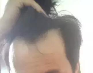 m型发际线,m型发际线怎么用发迹粉