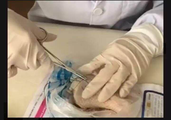 微整形玻尿酸可靠吗,玻尿酸微整形的危险