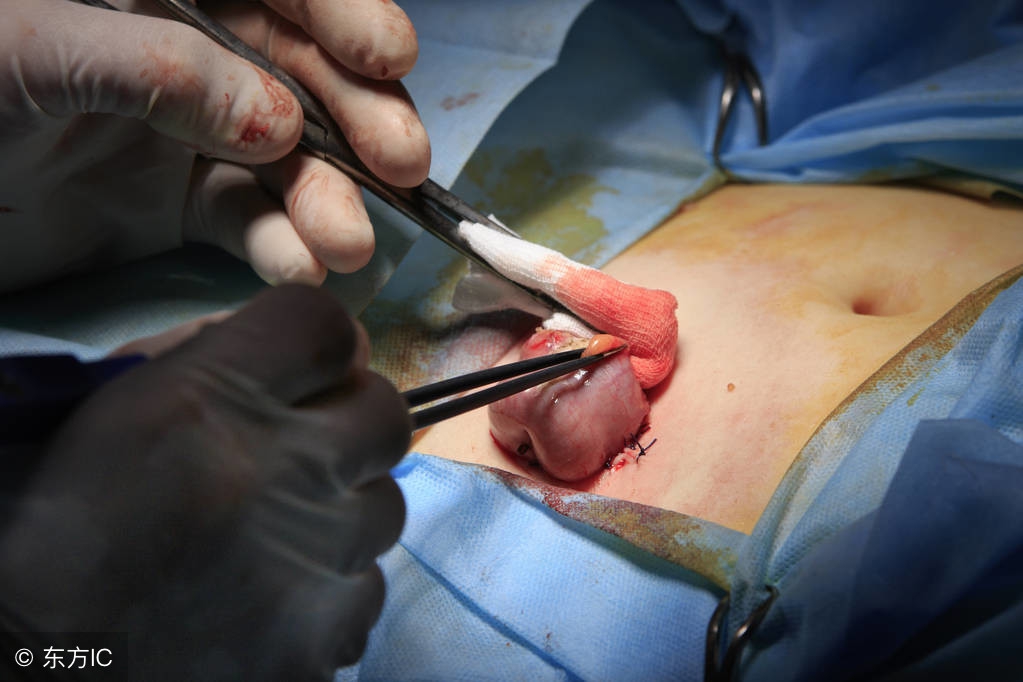 孕妇刚生完孩子，肚子竟又鼓起！医生再次剖腹后很吃惊……