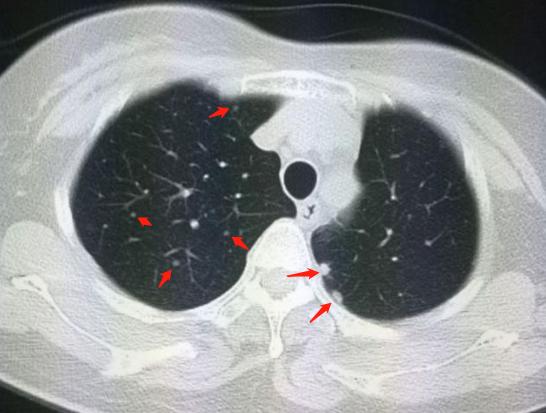 肺结节肺癌早期手术了会没事吧,肺结节肺癌早期手术能活多久