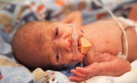 早产宝宝肠绞痛症状表现及护理,孩子早产怎么安慰爸爸妈妈