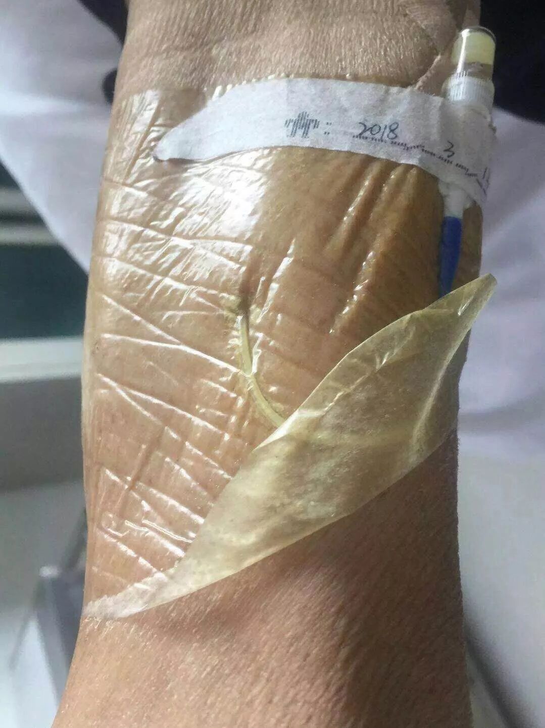 picc置管后周围肿胀原因及处理,picc管夏天怎么护理