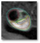 识别易损斑块方法,从了解到熟练五个阶段