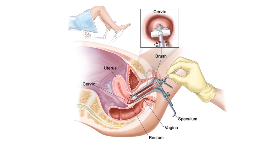 市面上有治疗HPV的药吗,网上治疗hpv的中药可信不