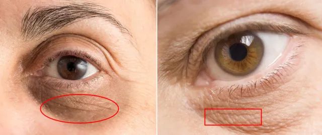 30岁眼角笑起来有皱纹,眼角笑起来有皱纹是老了吗