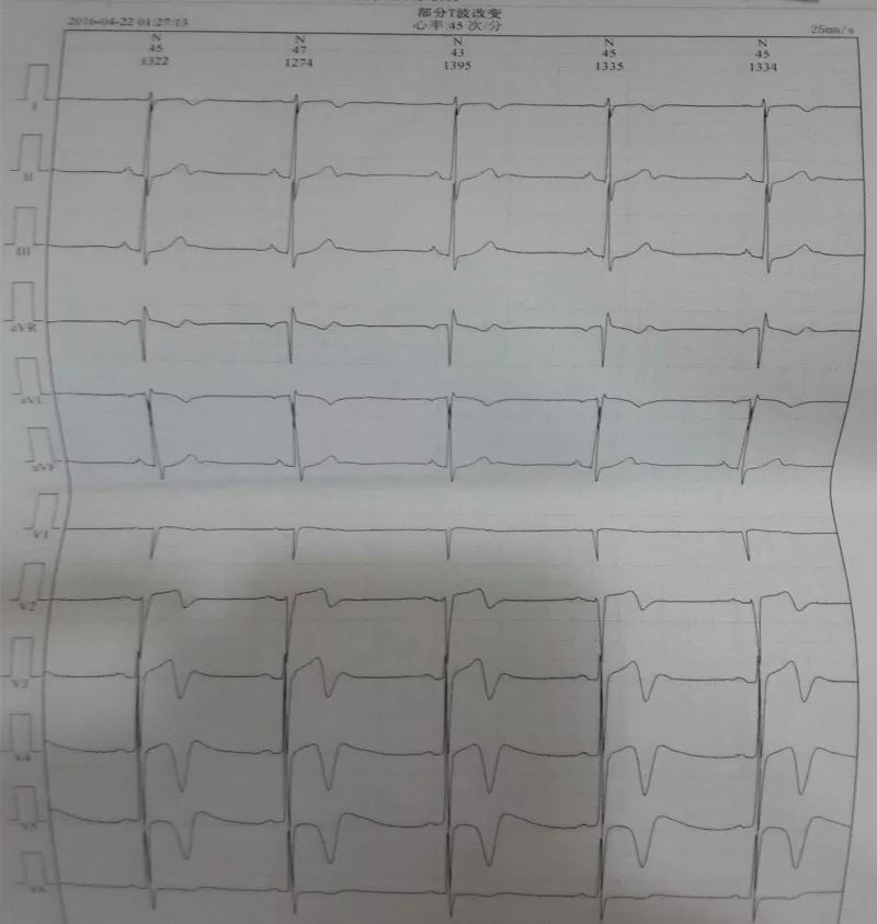 发作性胸痛心电图正常,心电图轻度T波改变图片