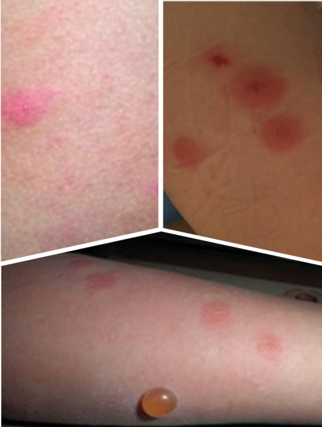 夏天来了脱皮,夏天会变成油皮吗