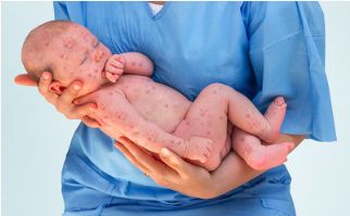 风疹病毒会导致胎儿什么畸形,风疹病毒导致胎儿先天性心脏病吗