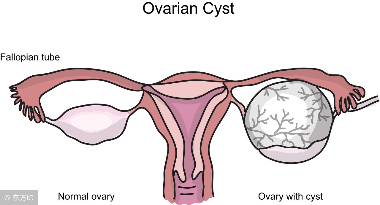 囊肿是肿瘤吗囊肿和肿瘤谁严重些,如何区分卵巢囊肿是囊肿还是肿瘤