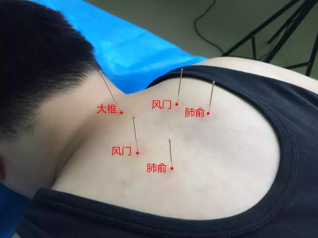 图解,看“邵氏五针法”治疗哮喘