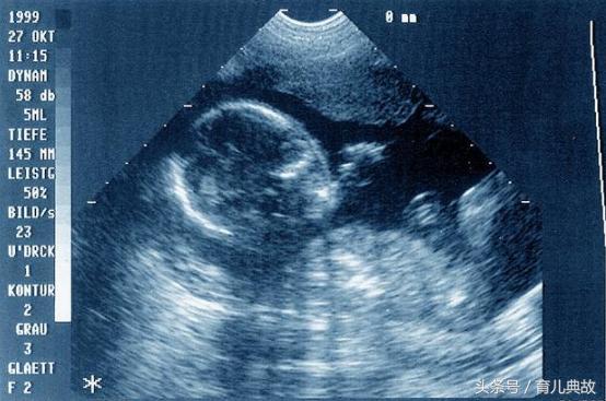 胎监要注意事项,胎监需要注意什么