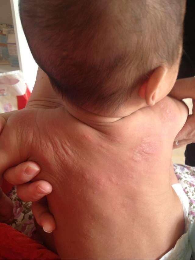 婴儿得了湿疹宝妈不能吃哪些食物,宝宝湿疹宝妈能吃什么不能吃什么