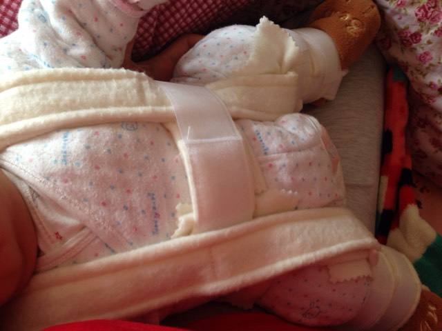 小孩臀纹不对称跛行,宝宝腿纹对称臀纹不对称做什么操